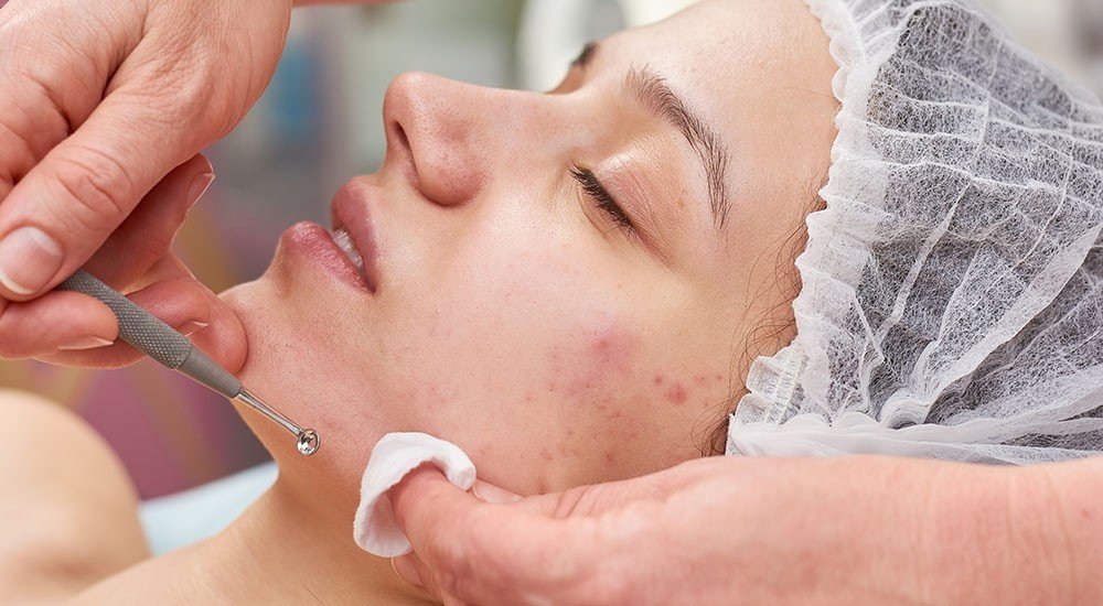 Acne Treatment Facial